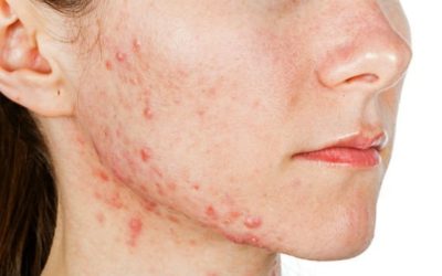Common Causes of Acne