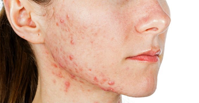 Woman's face with acne breakouts
