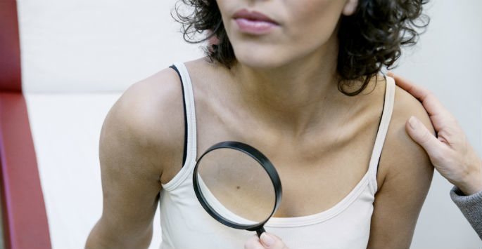 Doctor uses magnifying glass to examine mole if it is a skin cancer