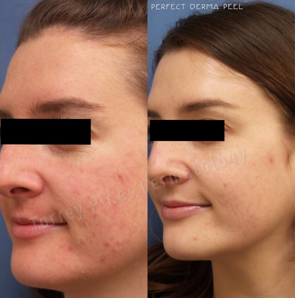 Derma Peel Before and After Photo by Torrey Pines Dermatology & Laser Center in La Jolla, CA