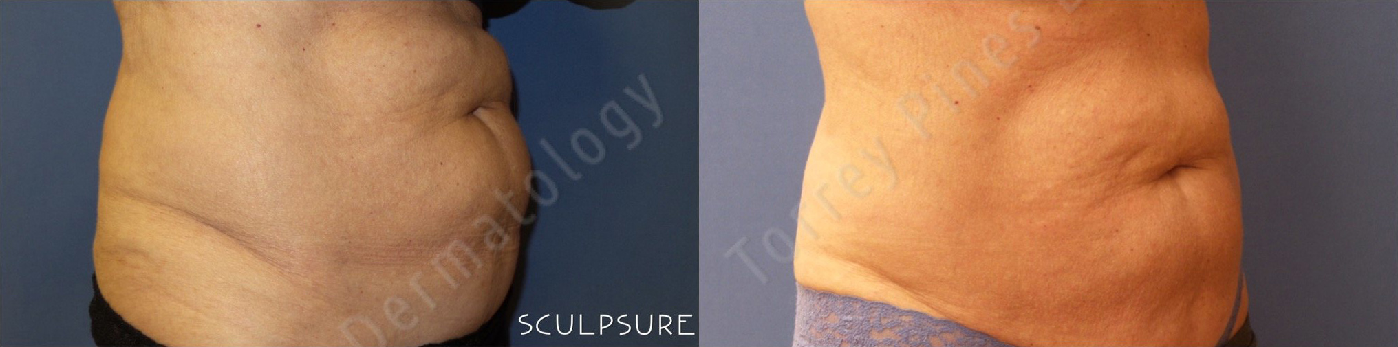 SculpSure® Before and After Photo by Torrey Pines Dermatology & Laser Center in La Jolla, CA