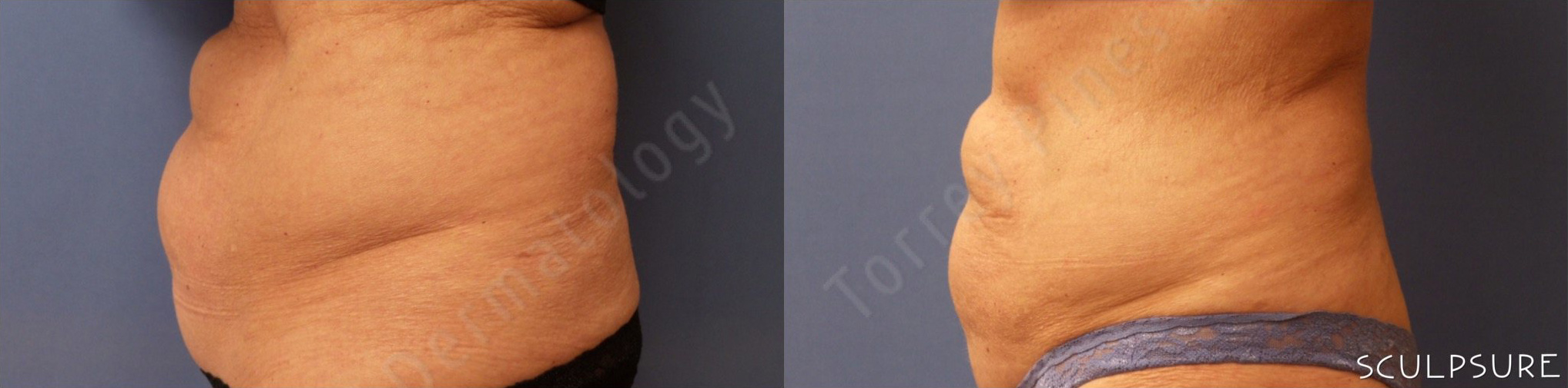 SculpSure® Before and After Photo by Torrey Pines Dermatology & Laser Center in La Jolla, CA