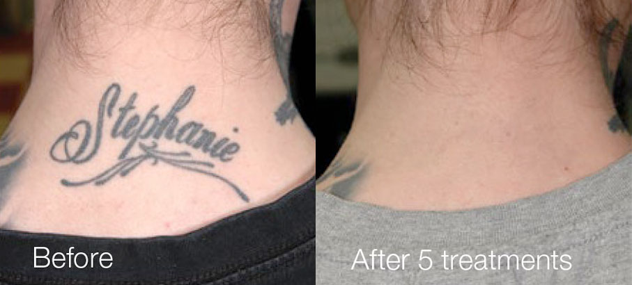 Tattoo Removal Before and After Photo by Torrey Pines Dermatology & Laser Center in La Jolla, CA