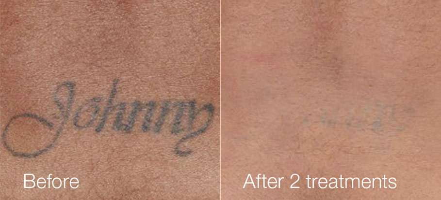 Tattoo Removal Before and After Photo by Torrey Pines Dermatology & Laser Center in La Jolla, CA