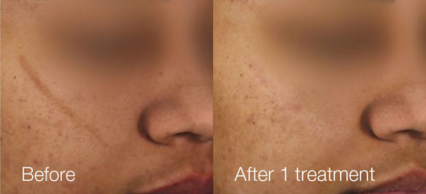 Pigment treatment Before and After Photo by Torrey Pines Dermatology & Laser Center in La Jolla, CA
