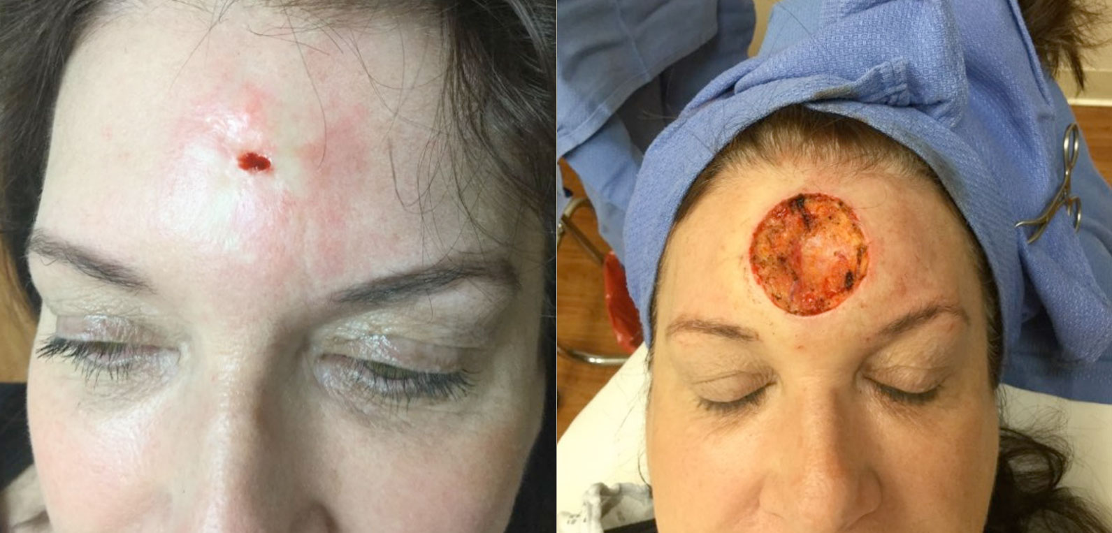 Mohs Surgery Before and After Photo by Torrey Pines Dermatology & Laser Center in La Jolla, CA