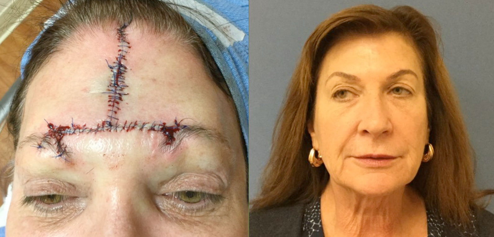 Mohs Surgery Before and After Photo by Torrey Pines Dermatology & Laser Center in La Jolla, CA