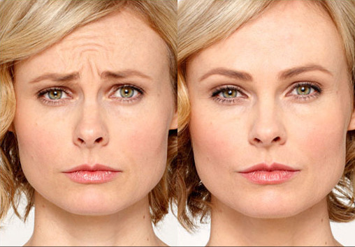 Dysport® Before and After Photo by Torrey Pines Dermatology & Laser Center in La Jolla, CA