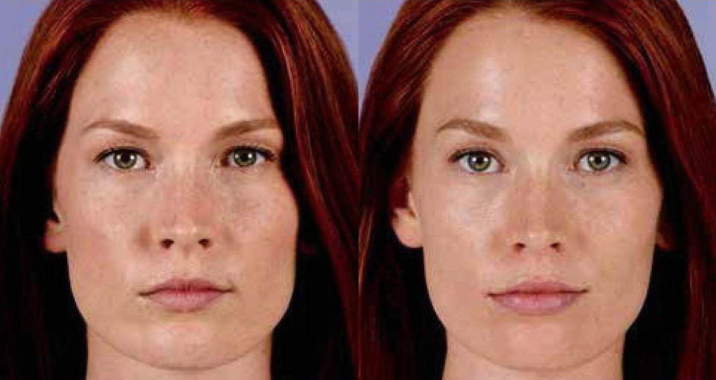 Juvederm Before and After Photo by Torrey Pines Dermatology & Laser Center in La Jolla, CA