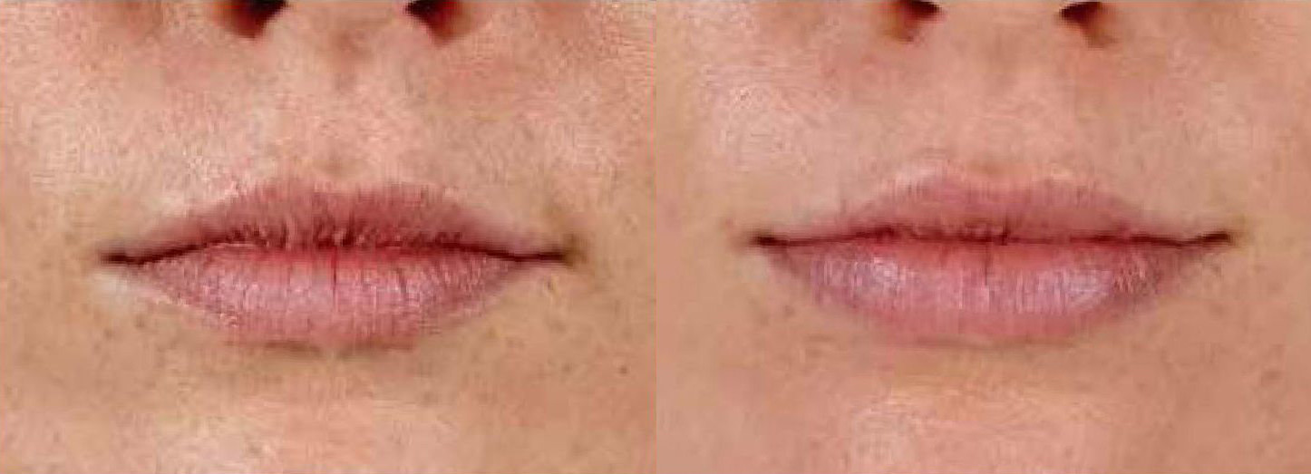 Juvederm Before and After Photo by Torrey Pines Dermatology & Laser Center in La Jolla, CA