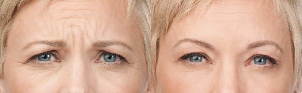Botox Before and After Photo by Torrey Pines Dermatology & Laser Center in La Jolla, CA