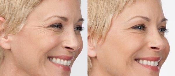 Botox Before and After Photo by Torrey Pines Dermatology & Laser Center in La Jolla, CA