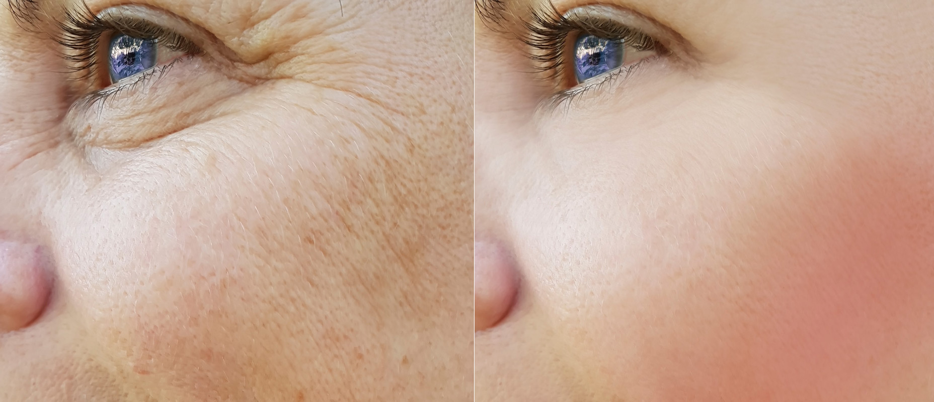 IPL Skin Brightening Lasers Before and After Photo by Torrey Pines Dermatology & Laser Center in La Jolla, CA