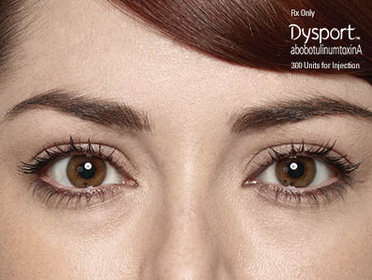 Dysport Before and After Photo by Torrey Pines Dermatology in La Jolla, California