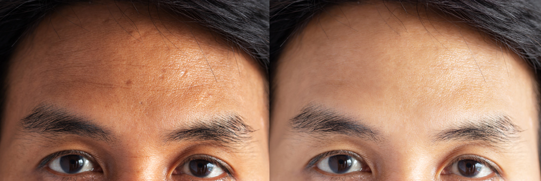 Cosmetic Dermatology For Men Before and After Photo by Torrey Pines Dermatology & Laser Center in La Jolla, CA