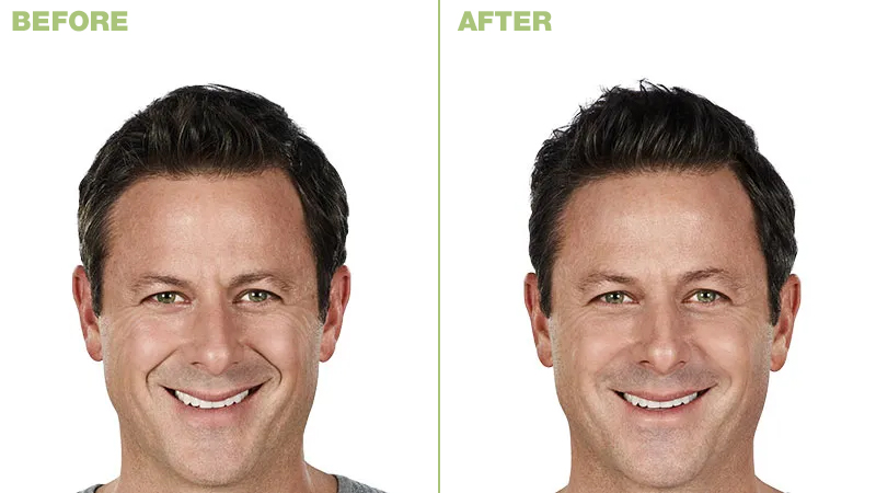 Juvederm Ultra Plus Before and After Photo by Torrey Pines Dermatology & Laser Center in La Jolla, CA