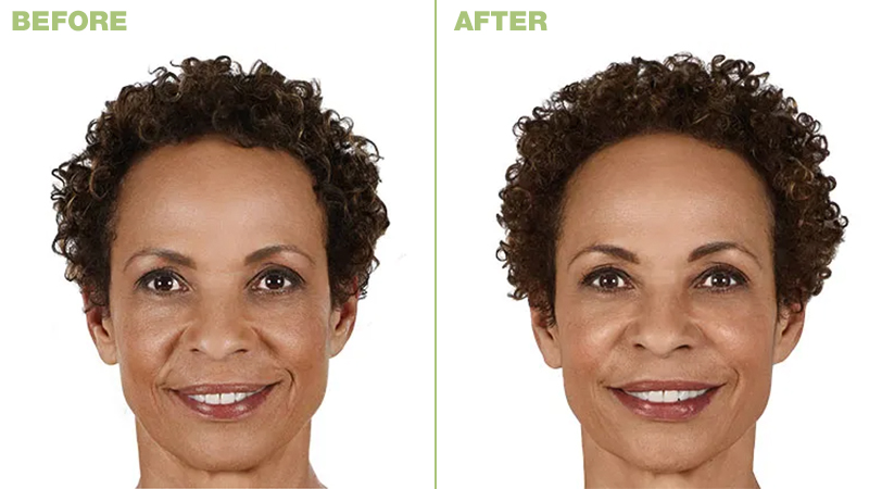 Juvederm Vollure XC Before and After Photo by Torrey Pines Dermatology & Laser Center in La Jolla, CA