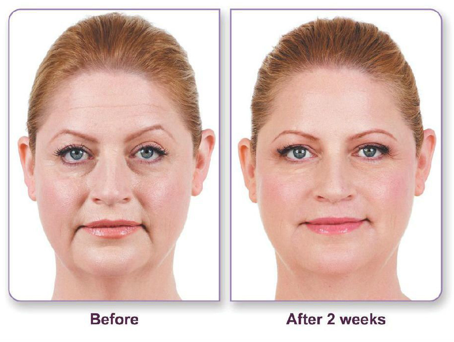 Juvederm Before and After Photo by Dr. Richards in La Jolla, CA