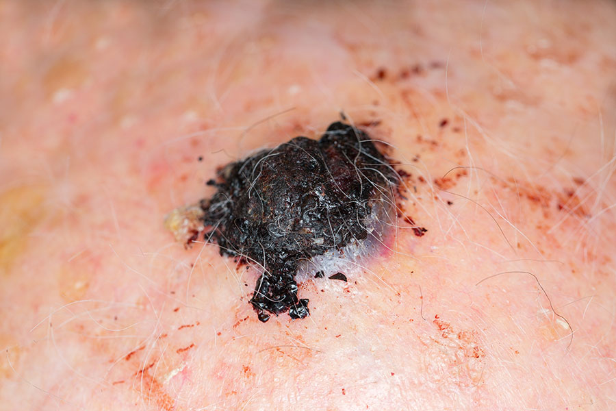 Malignant melanoma on the head of an old caucasian man