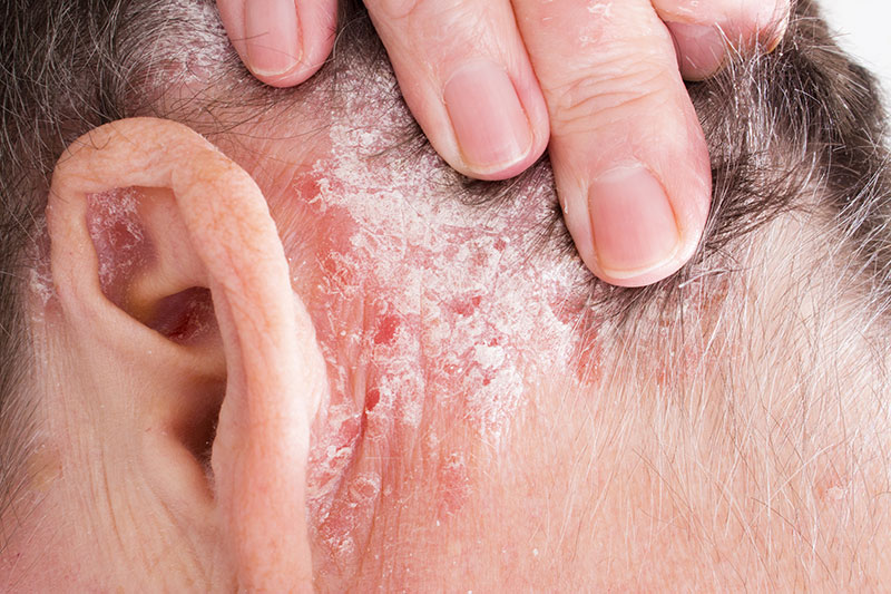 Woman with psoriasis behind the ear