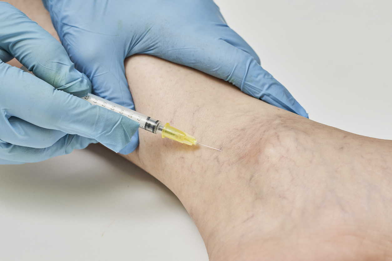 Varicose veins diagnosis and treatment. A doctor injects a syringe under the knee. A doctor makes injection to varicose veins on womans leg. Sclerotherapy, stripping, phlebeurysm, medical concepts