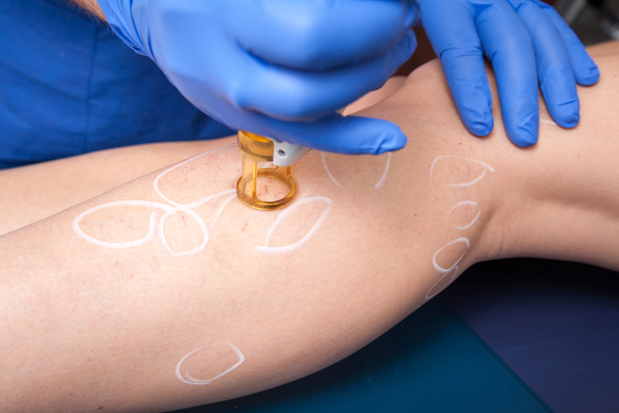 Removing spider veins with medical laser