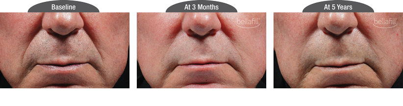 Bellafill Before and After Photo by Torrey Pines Dermatology in La Jolla, California