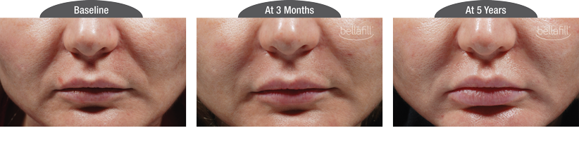 Bellafill® Before and After Photo by Torrey Pines Dermatology & Laser Center in La Jolla, CA