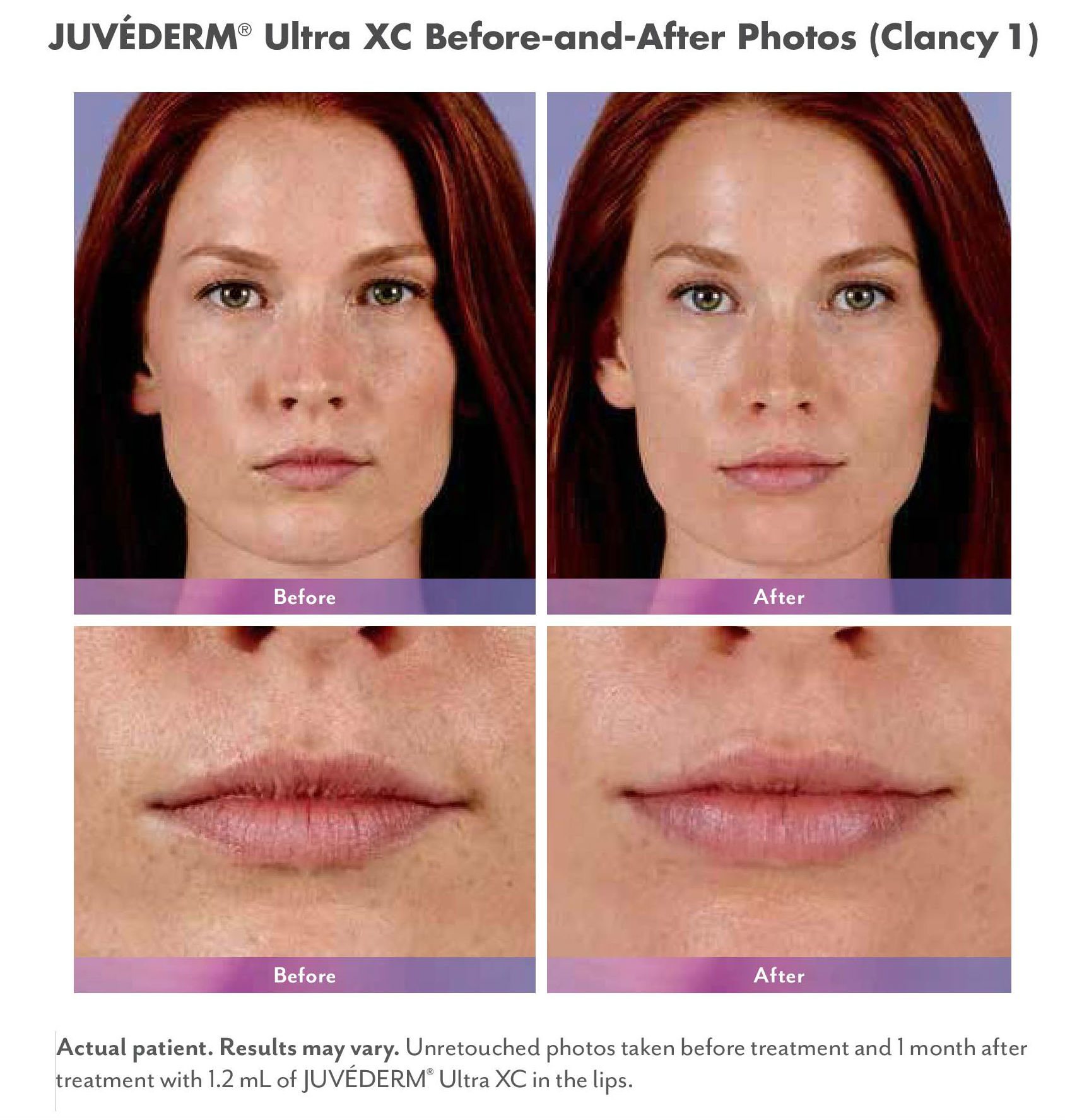 Juvederm Before and After Photo by Dr. Richards in La Jolla, CA 