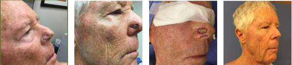 Mohs Before and After Photo by Torrey Pines Dermatology in La Jolla, California