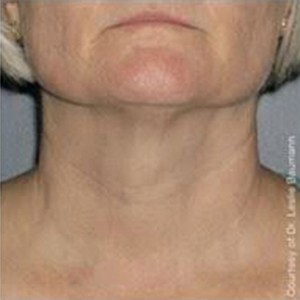 Ultherapy Before and After Photo by Torrey Pines Dermatology in La Jolla, California