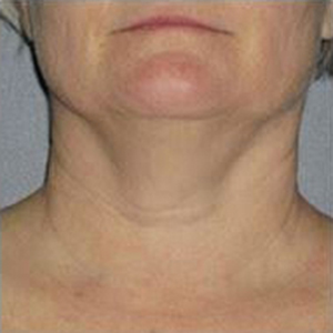 Ultherapy Before and After Photo by Torrey Pines Dermatology in La Jolla, California