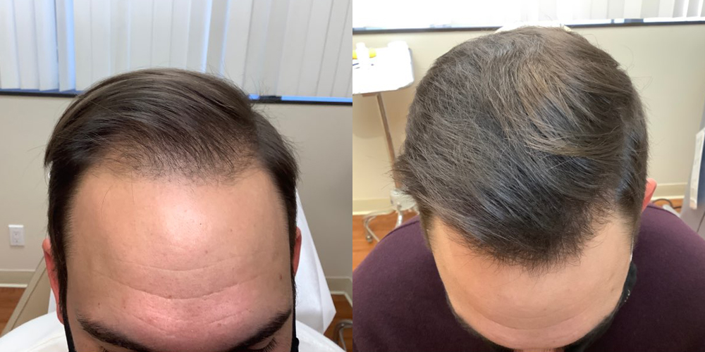 Microneedling with PRP Before and After Photo by Torrey Pines Dermatology & Laser Center in La Jolla, CA