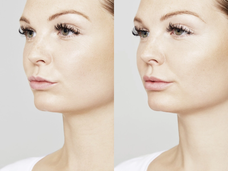 Restylane® Before and After Photo by Torrey Pines Dermatology & Laser Center in La Jolla, CA