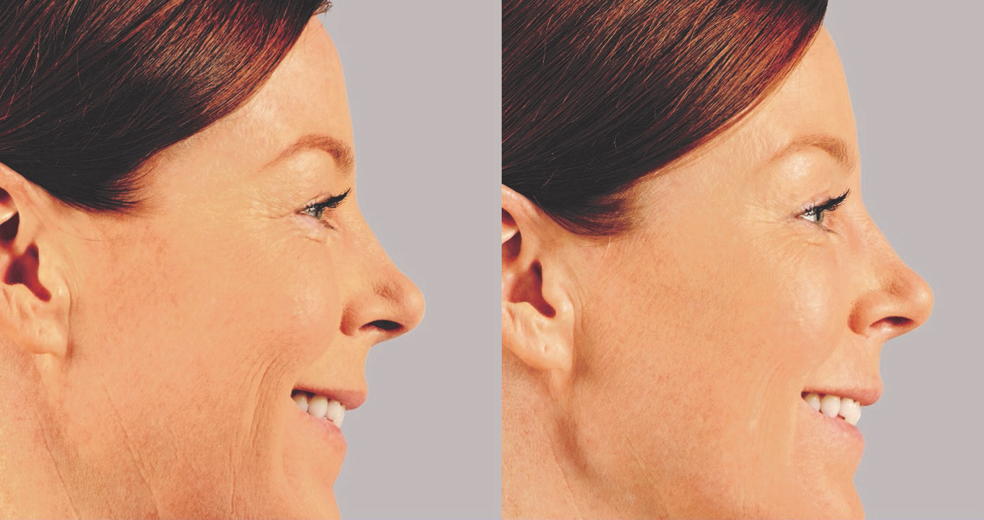 Voluma Before and After Photo by Torrey Pines Dermatology & Laser Center in La Jolla, CA