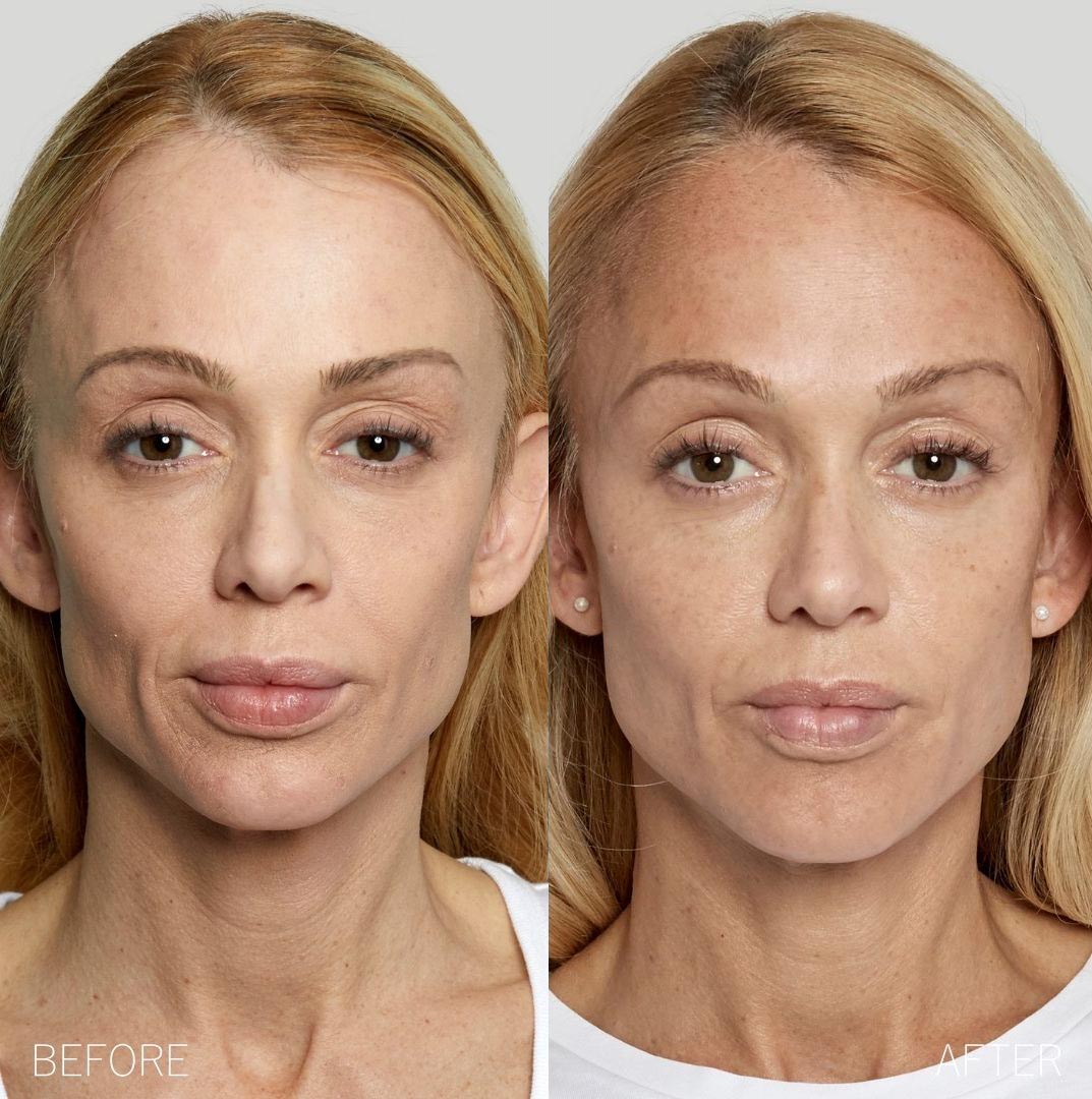 Sculptra® Before and After Photo by Torrey Pines Dermatology & Laser Center in La Jolla, CA