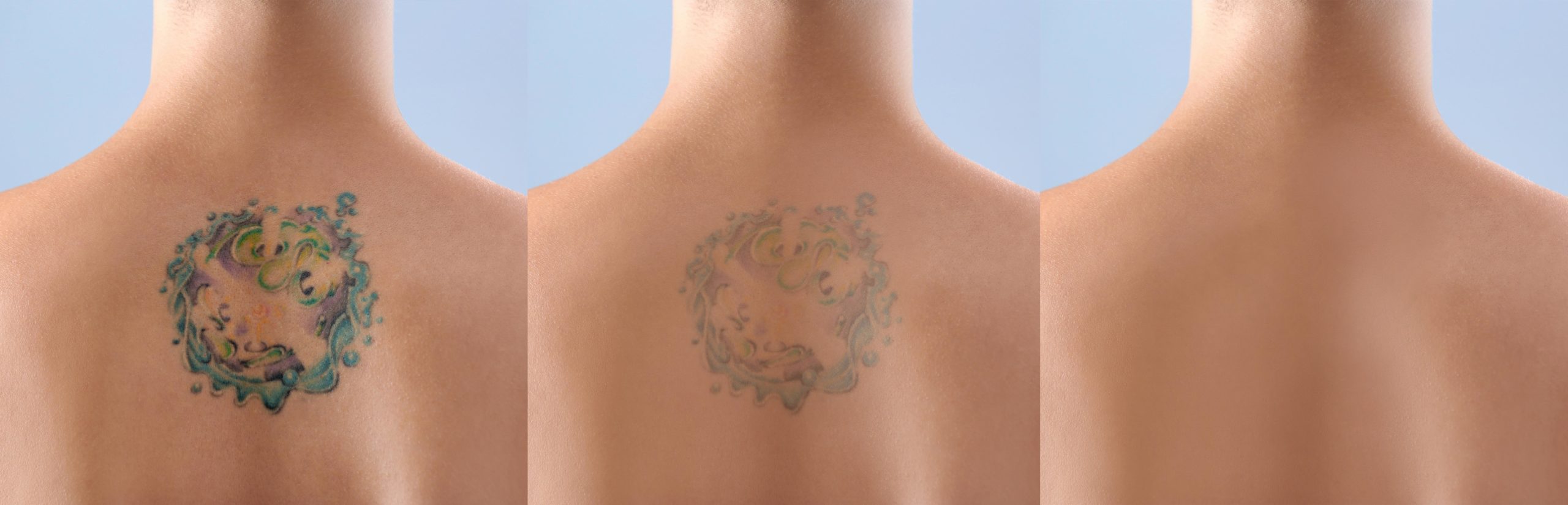 Tattoo Removal Before and After Photo