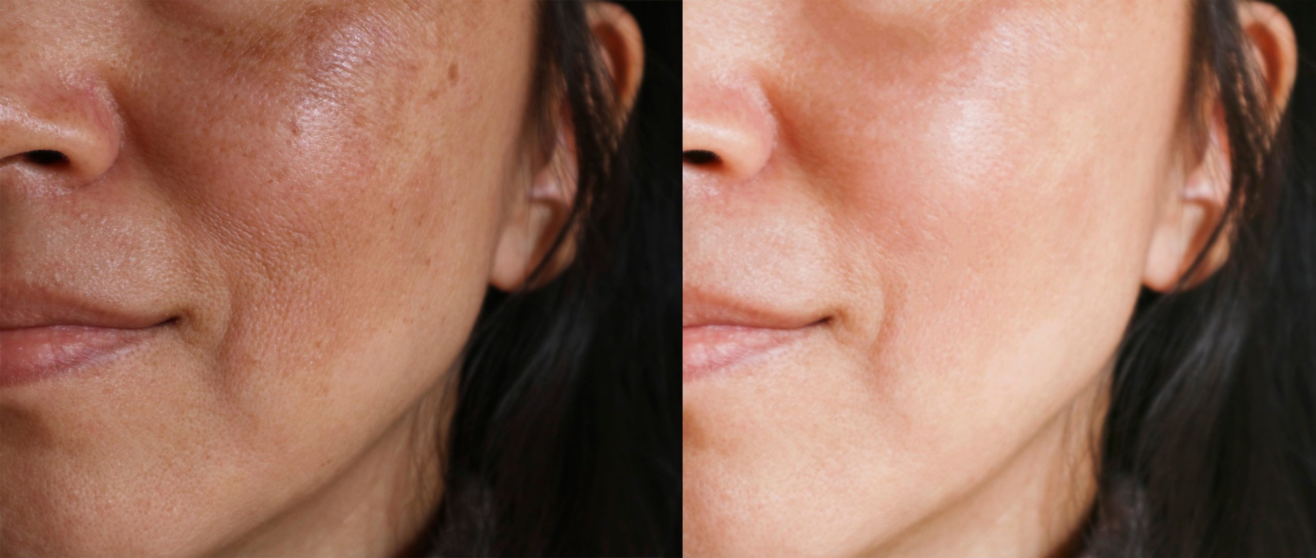 Laser Genesis Before and After Photo by Torrey Pines Dermatology & Laser Center in La Jolla, CA