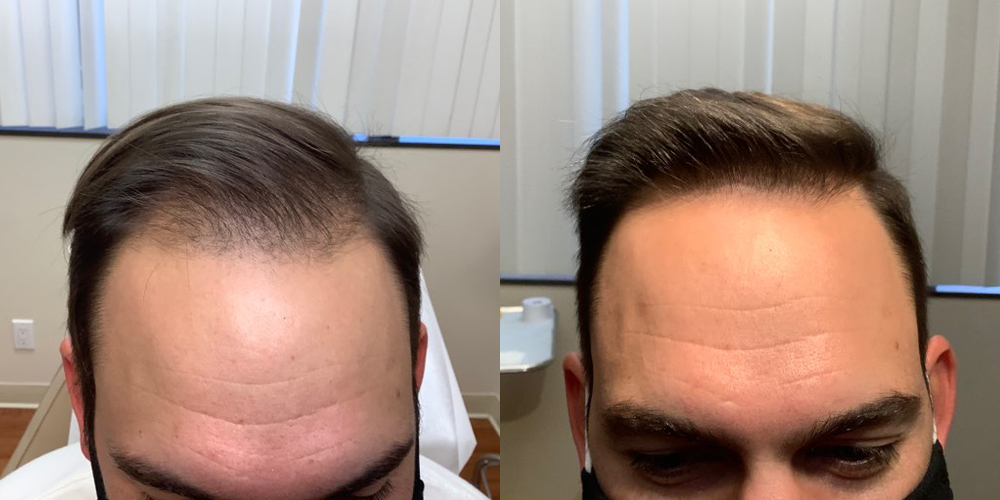 Microneedling with PRP Before and After Photo by Torrey Pines Dermatology & Laser Center in La Jolla, CA