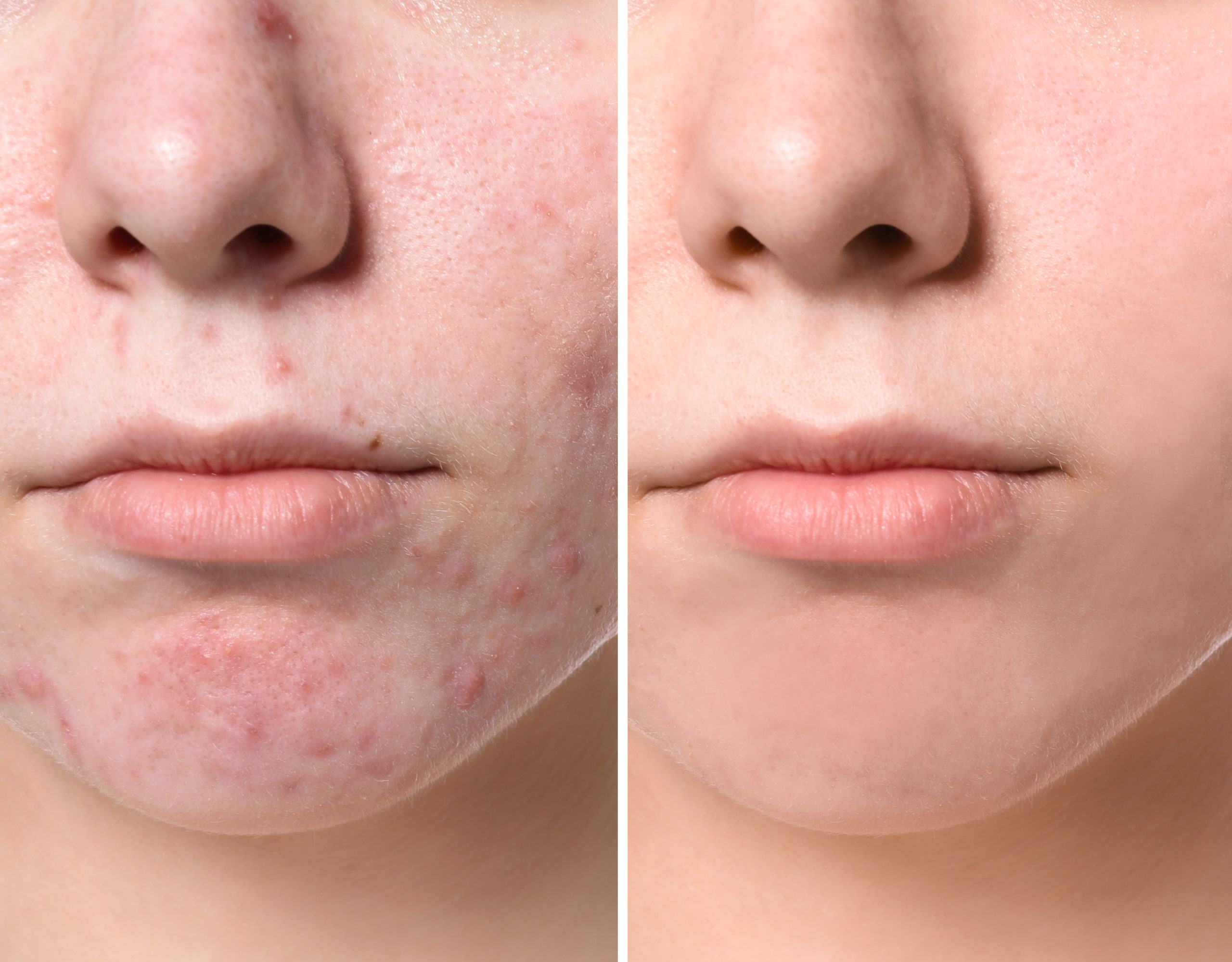 Blu Lite Before and After Photo by Torrey Pines Dermatology & Laser Center in La Jolla, CA