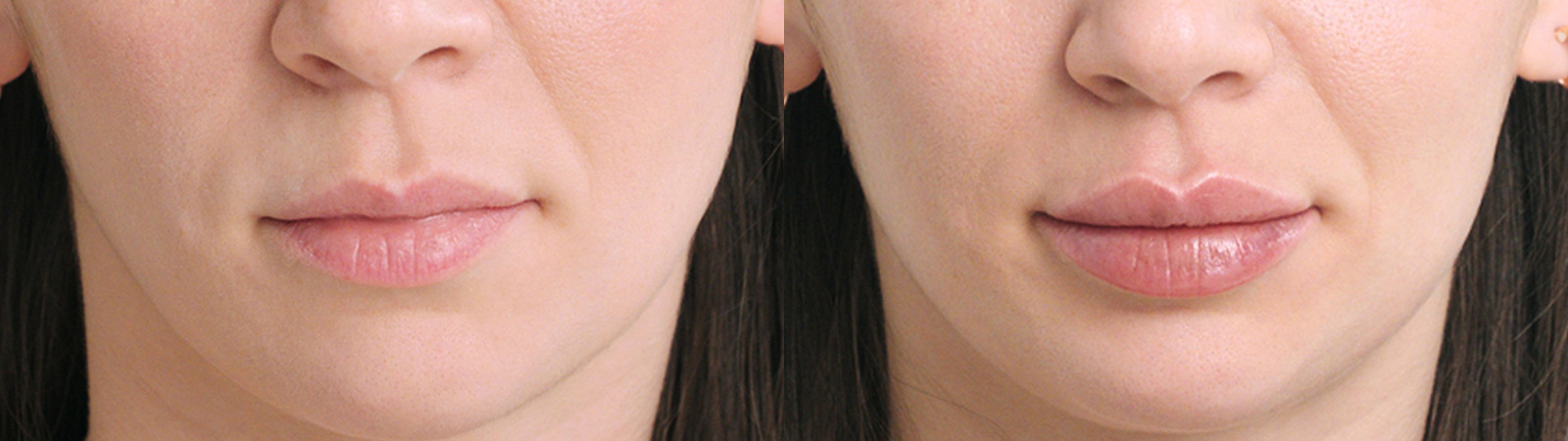 Restylane® Before and After Photo by Torrey Pines Dermatology & Laser Center in La Jolla, CA