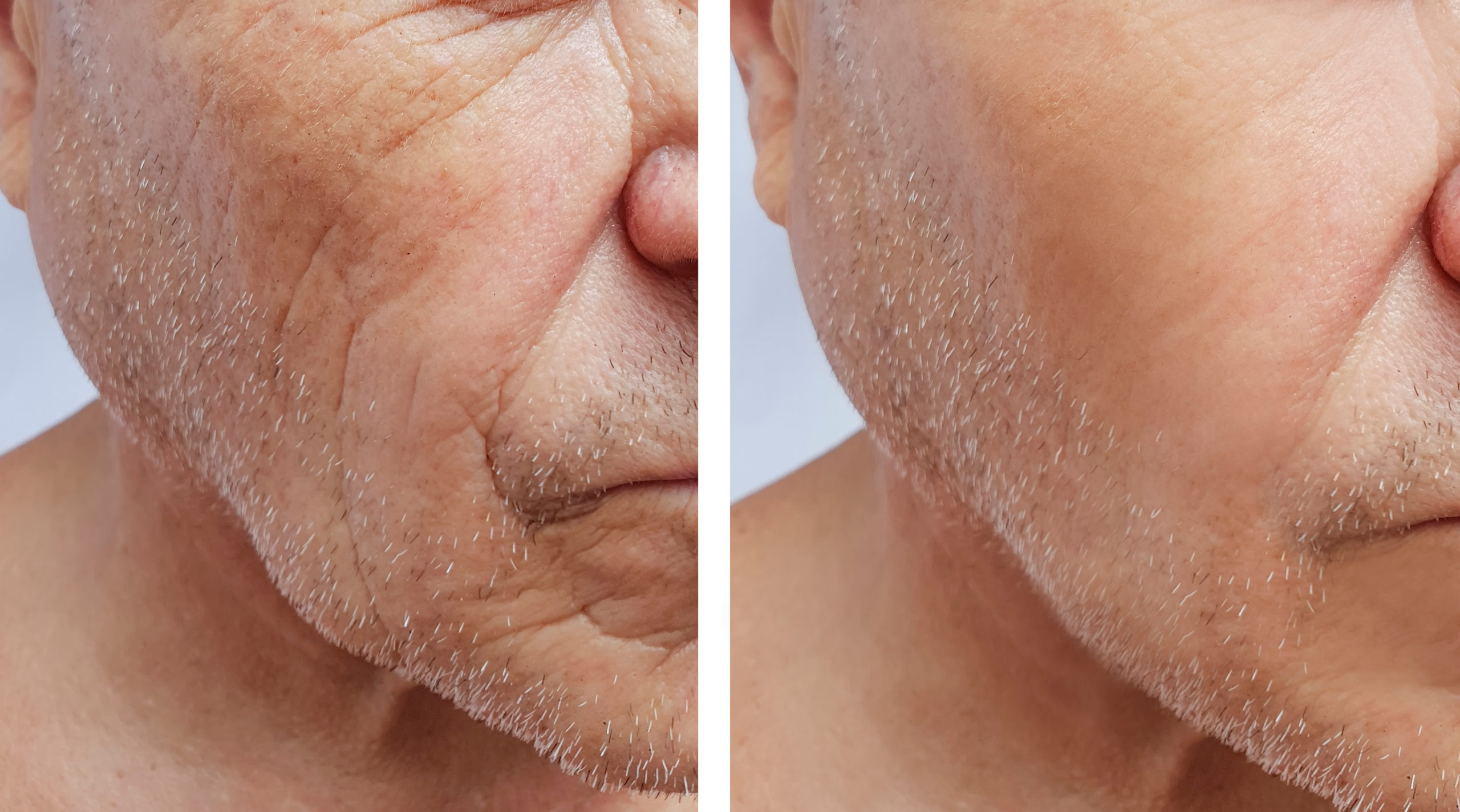 ActiveFX Before and After Photo by Torrey Pines Dermatology & Laser Center in La Jolla, CA