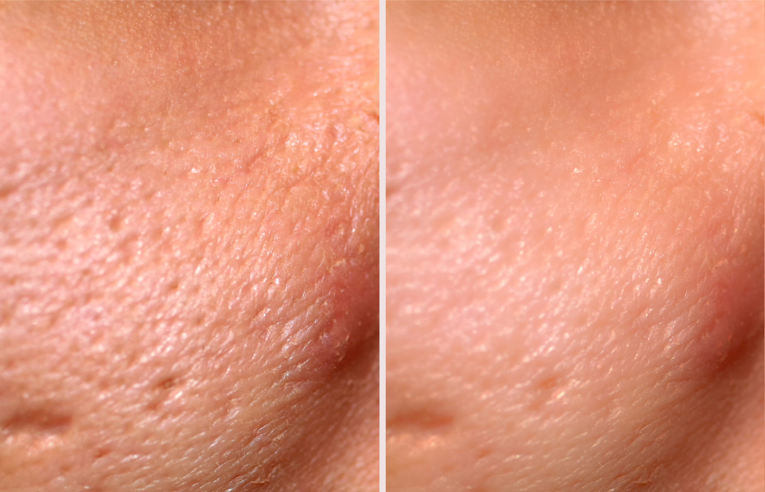 DeepFX Before and After Photo by Torrey Pines Dermatology & Laser Center in La Jolla, CA