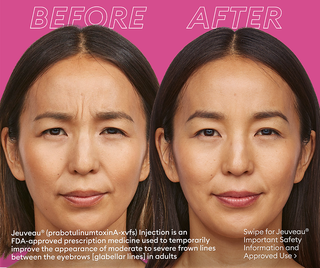 Jeuveau Before and After Photo by Torrey Pines Dermatology & Laser Center in La Jolla, CA