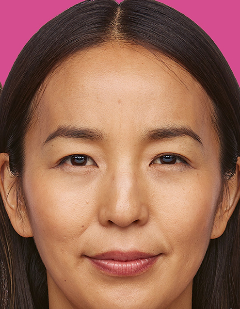 Jeuveau Before and After Photo by Torrey Pines Dermatology in La Jolla, California