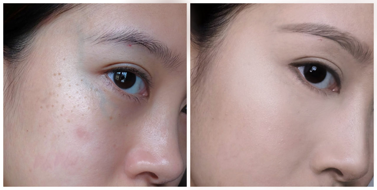 Nd yag archives torrey pines dermatology laser center