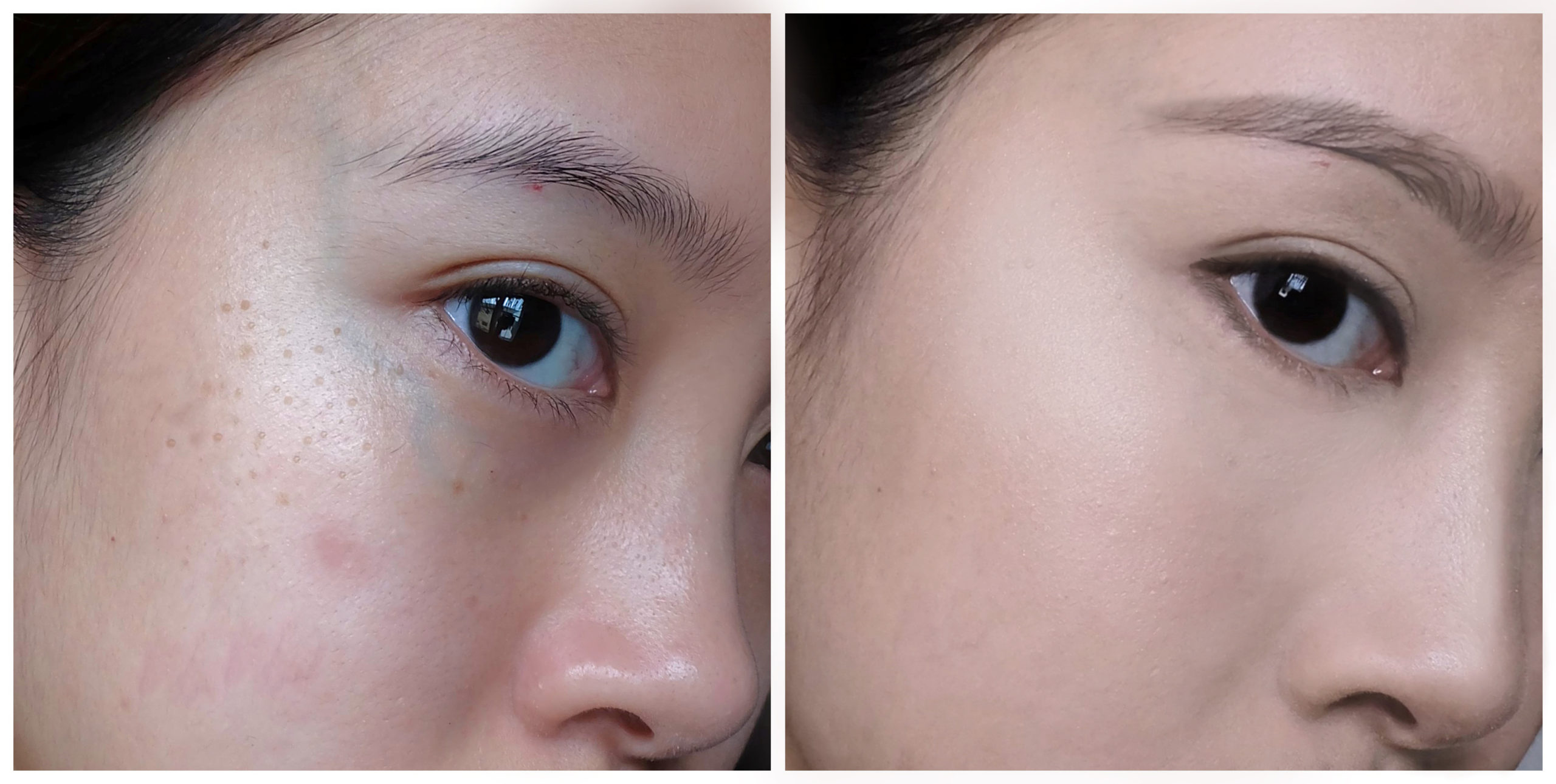 Nd:YAG Before and After Photo by Torrey Pines Dermatology & Laser Center in La Jolla, CA