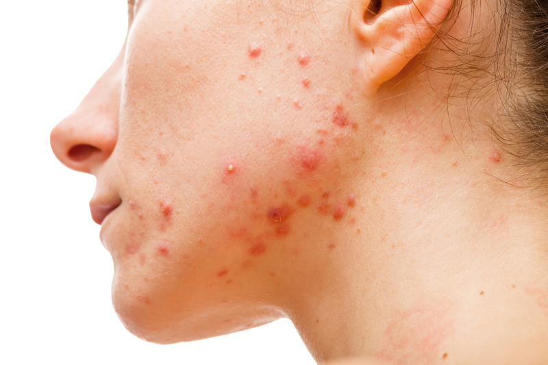 Woman with acne skin