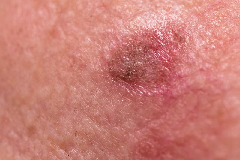 Actinic keratosis or sunspots on a cheek