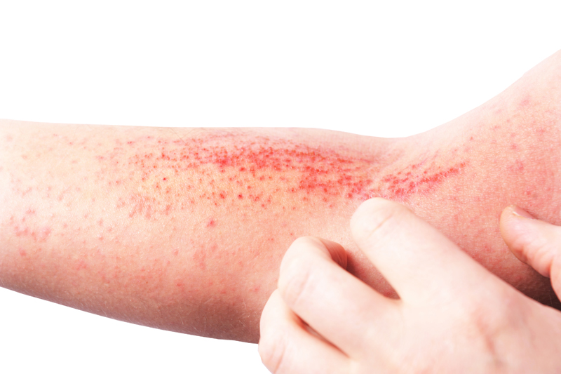 Atopic dermatitis (eczema) inside elbow